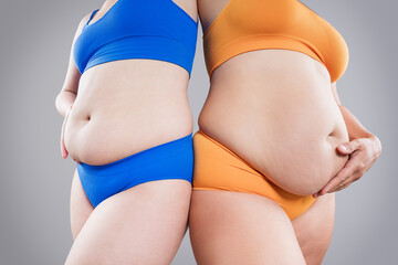 Tummy tuck, two fat women with cellulitis and flabby bellies on gray background, obese female body, plastic surgery and liposuction concept - 779510125
