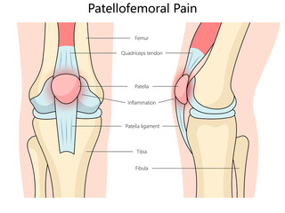Patellofemoral pain syndrome structure diagram hand drawn schematic raster illustration. Medical science educational illustration