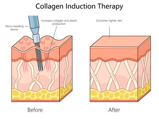 skin structure before and after collagen induction therapy using a micro-needling device for enhanced skin texture diagram schematic raster illustration. Medical science educational illustration - 779538379