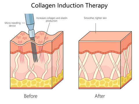 skin structure before and after collagen induction therapy using a micro-needling device for enhanced skin texture diagram schematic raster illustration. Medical science educational illustration