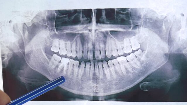 Dentist shows the x-ray of patient's tooth on monitor. Slow motion