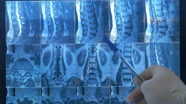 The doctor shows abnormalities, problems in the patient's spine on an MRI scan. The doctor views the patient's spine on x-rays