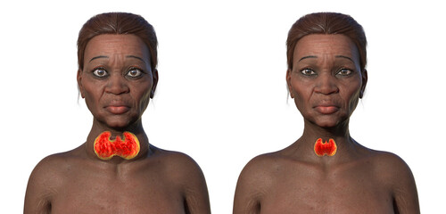 An African woman with Graves' disease and her healthy counterpart, 3D illustration