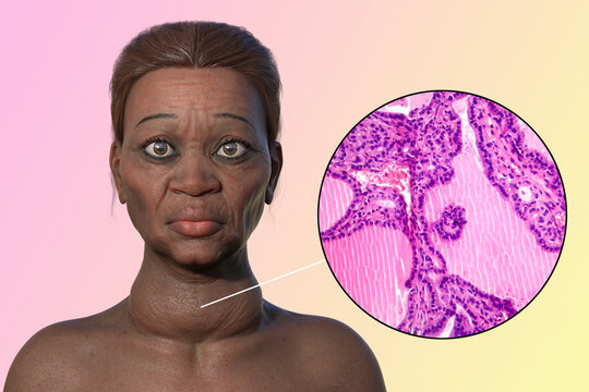 Grave's disease in a woman, 3D illustration and light micrograph of toxic goiter