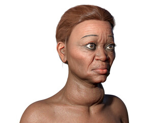 Grave's disease in a woman, 3D illustration