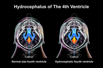 Enlargement of the fourth brain ventricle, 3D illustration - obrazy, fototapety, plakaty