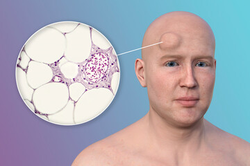 Lipoma on a man's forehead, 3D illustration and micrograph