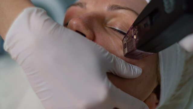 RF Microneedling Therapy: Minimally Invasive Treatment for Skin Lifting and Targeted Skin Rejuvenation. High quality 4k footage