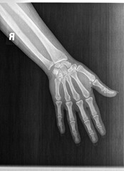 Film xray or radiograph of a normal left hand of an adult male. AP view show human's hand. normal bone structure of all phalanges carpal bones metacarpal, distal radius and ulna. joint space is normal - obrazy, fototapety, plakaty