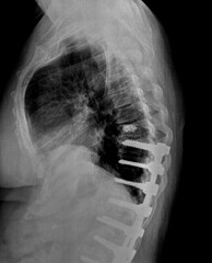 Film xray or radiograph of a mid back thoracic vertebrae . Lateral side view showing surgical...