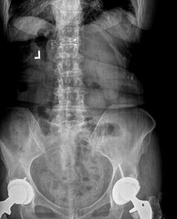 Film xray or radiograph of a lumbar spine, pelvis and hip. AP anterior posterior view showing...