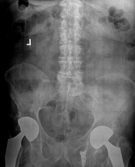 Film xray or radiograph of a lumbar spine, pelvis and hip. AP anterior posterior view showing...