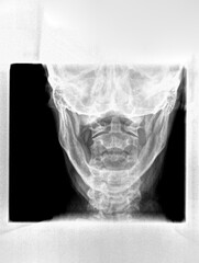 Film xray or radiograph of a cervical neck. AP open mouth anterior posterior view which is the best...