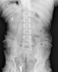 Film x ray or radiograph of a normal adult lumbar vertebrae anterior posterior AP view showing...