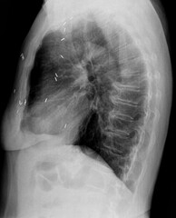 Film xray or radiograph of a mid back thoracic vertebrae . Lateral side view showing surgical...