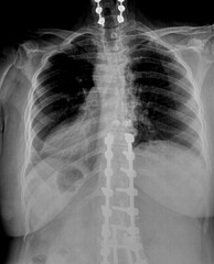 Film xray or radiograph of a mid back thoracic and cervical vertebrae amterior posterior view...
