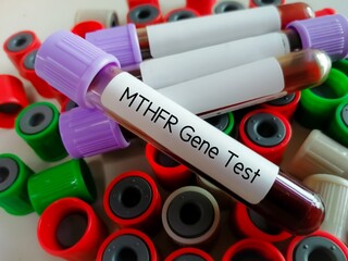 Blood sample for MTHFR gene test. Methylenetetrahydrofolate reductase