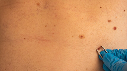 Doctor in medical gloves examining man skin mole for size. Dermatologist checking male birthmarks....