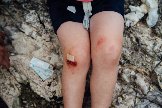 Close up of child's skinned knee with bandages and wrappers.