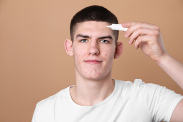 Young man with acne problem applying cosmetic product onto his skin on beige background. Space for...