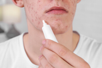 Young man with acne problem applying cosmetic product onto his skin indoors, closeup