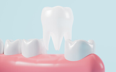 Human tooth model, tooth implantation, orthodontics, 3d rendering.