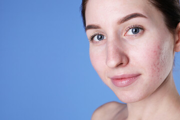 Young woman with acne problem on blue background, closeup. Space for text