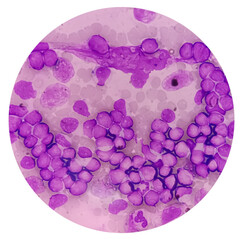 Acute leukemia, ALL(Acute lymphoblastic leukemia), peripheral blood smear, Under 100x light microscope to diagnosis of Acute leukemia.