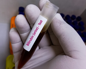 Technician holding urine sample for Bilirubinuria test, urine bilirubin test, urine analysis.