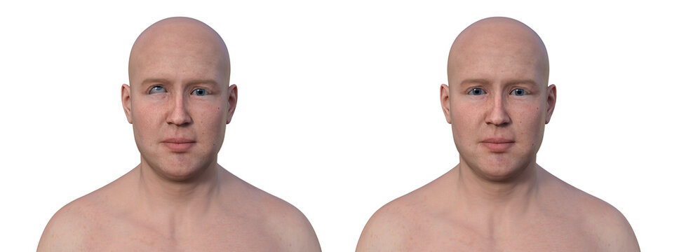 A man with hypertropia and a healthy person, 3D illustration