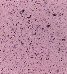 UTI. Budding yeast cells and calcium oxalate crystal in urine, urinary tract infections.