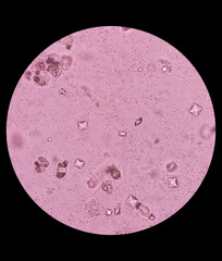 UTI. Budding yeast cells and calcium oxalate crystal in urine, urinary tract infections.