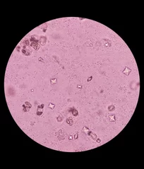 Fotobehang UTI. Budding yeast cells and calcium oxalate crystal in urine, urinary tract infections. © MdBabul