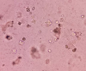 Fotobehang UTI. Budding yeast cells and calcium oxalate crystal in urine, urinary tract infections. © MdBabul
