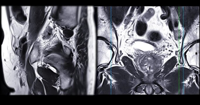 MRI of the prostate gland reveals A 2.0x0.9x1.7 cm malignant prostate tumor at left posterior PZ, aiding in diagnosing tumors and guiding treatment decisions.