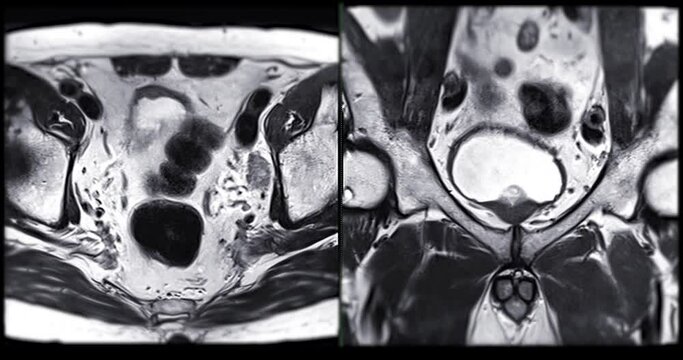 MRI of the prostate gland reveals A 2.0x0.9x1.7 cm malignant prostate tumor at left posterior PZ, aiding in diagnosing tumors and guiding treatment decisions.