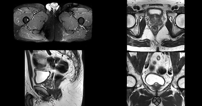 MRI of the prostate gland reveals A 2.0x0.9x1.7 cm malignant prostate tumor at left posterior PZ, aiding in diagnosing tumors and guiding treatment decisions.