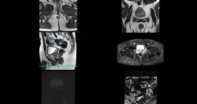 MRI of the prostate gland reveals A 2.0x0.9x1.7 cm malignant prostate tumor at left posterior PZ, aiding in diagnosing tumors and guiding treatment decisions.