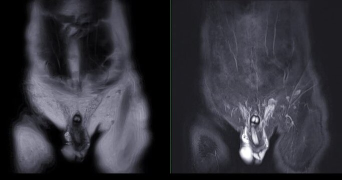 MRI of the prostate gland, revealing an enlarged size, aids in diagnosing tumors, guiding treatment decisions, and monitoring prostate health.