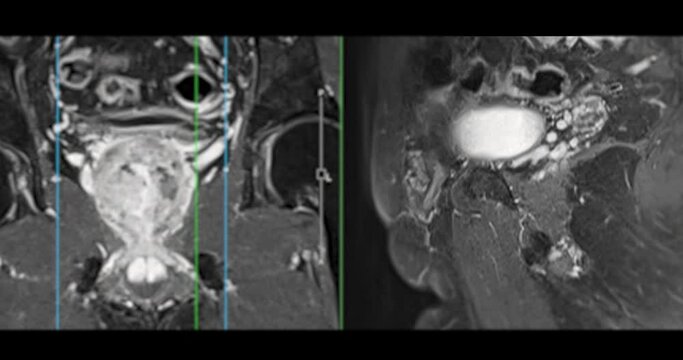 MRI of the prostate gland, revealing an enlarged size, aids in diagnosing tumors, guiding treatment decisions, and monitoring prostate health.