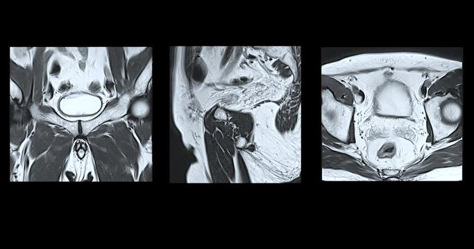 MRI of the prostate gland, revealing an enlarged size, aids in diagnosing tumors, guiding treatment decisions, and monitoring prostate health.