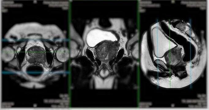 
MRI of the prostate gland reveals a focal abnormal signal intensity (SI) lesion at the left posterolateral peripheral zones at the apex, aiding in diagnosing tumors and guiding treatment decisions.