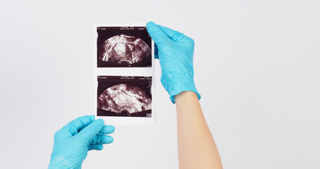 Hand hold uterus and ovary ultrasound paper print result on white background.Hands wear latex glove