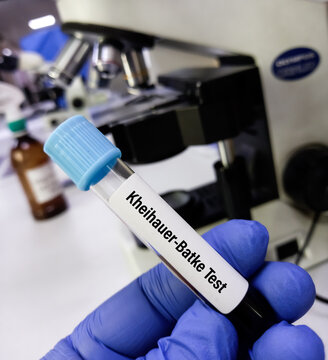 Kleihauer&ndash;Betke test or Kleihauer test, is utilized to determine if there is fetal blood in maternal circulation, Foeto-maternal haemorrhage (FMH).