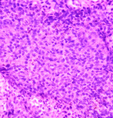 Parotid swelling cytology, Monomorphic adenoma. Smear show cellular material of epithelial cells in clusters and singly on the background of blood.