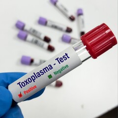 Blood sample for Toxoplasma test at laboratory background.