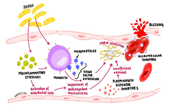 Pathogenesis of Disseminated Intravascular Coagulation 