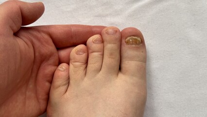 Close-up of the person nails affected by nail plate fungus. Ugly toes. Onychosis of nails. Close-up.