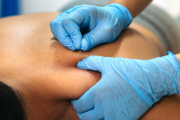 Physiotherapy Clinic: Dry Needling