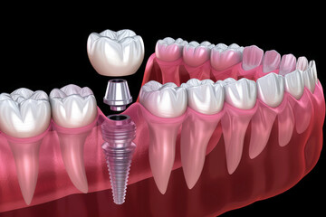 Fototapeta na wymiar Dental Implant Procedure Implant Supported Teeth. Generative AI
